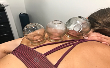 cupping reduce discomfort and decrease pain thresholds temporarily